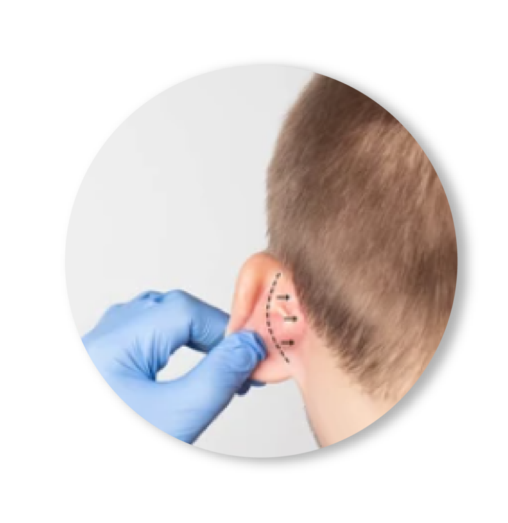 OTOPLASTIA- colombia