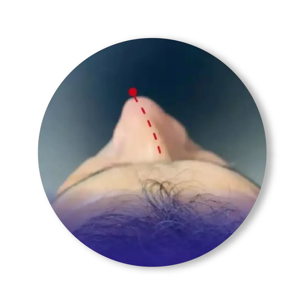 RINOPLASTIA funcional