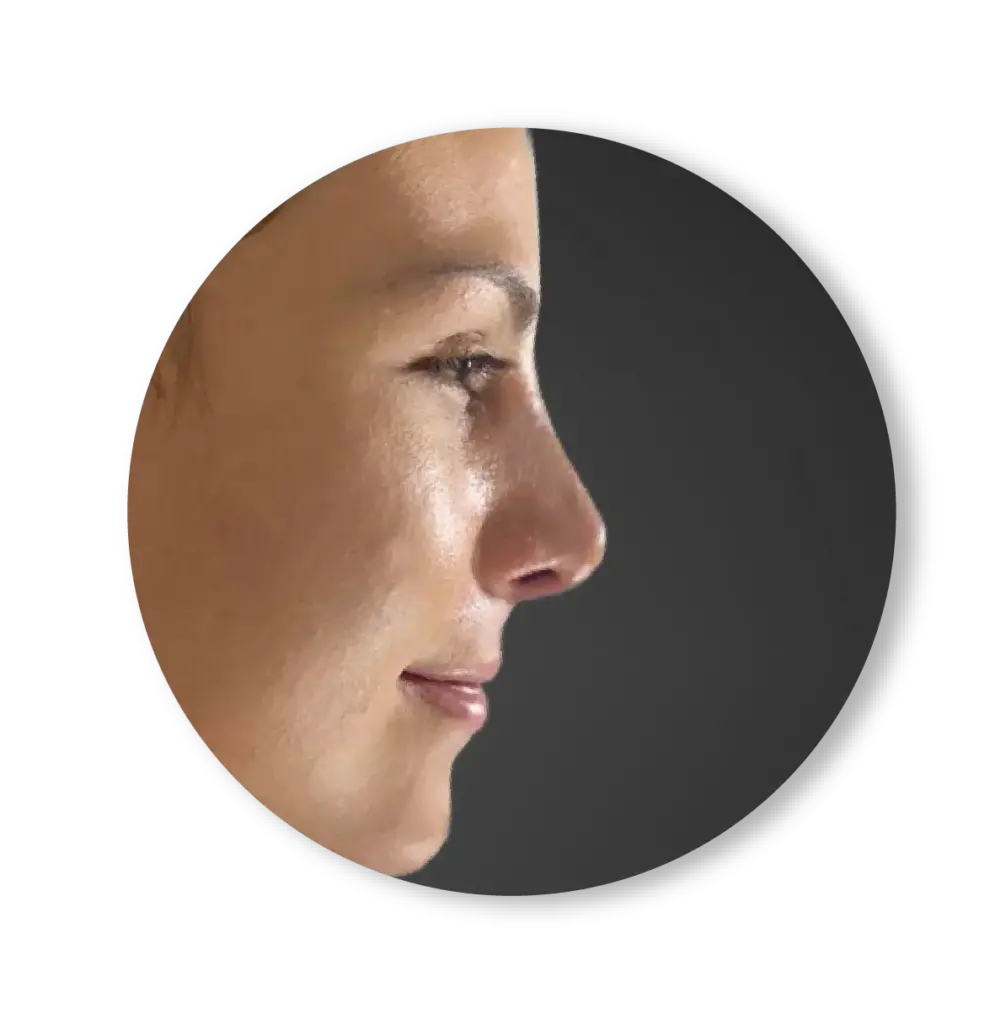 rinoplastia, CIRUGÍA DE NARIZ, Cirugía estética